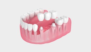 Dental Bridge After Tooth Extraction: Timeline and Expectations